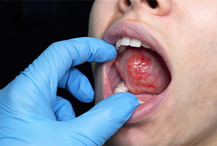 Oral Cavity Cancer