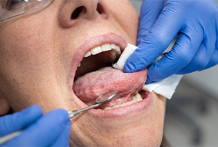 Oropharyngeal Cancer