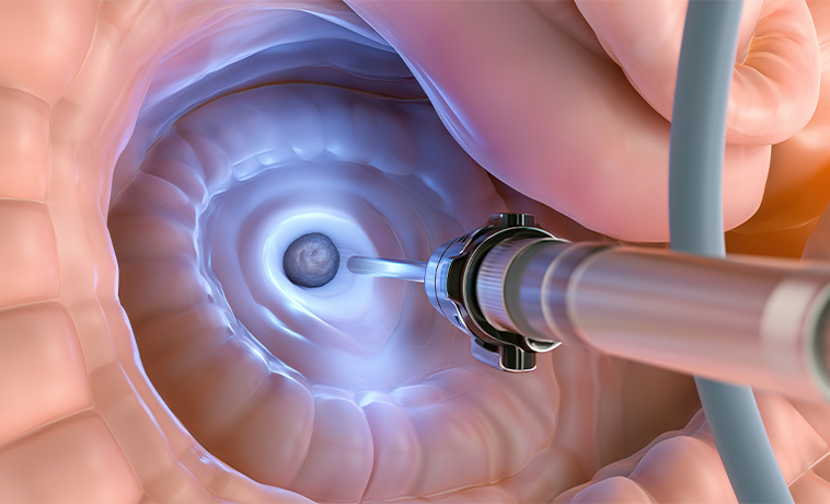 Endoscopic Biopsy