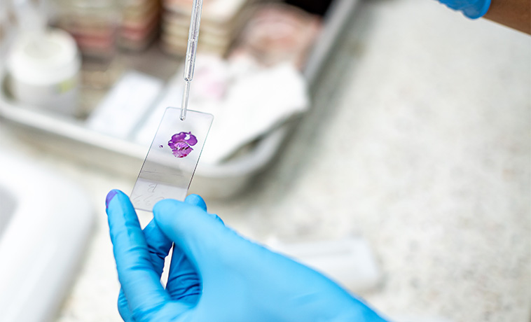 Excisional Biopsy