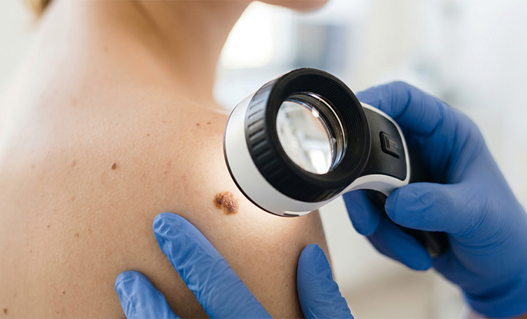 Incisional Biopsy
