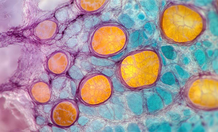 Sentinel Lymph-Node Biopsy