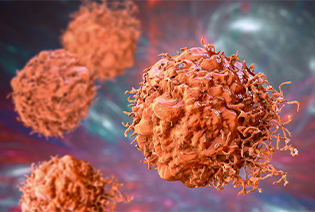 Urethral Cancer