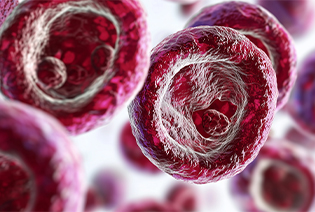 Acute Myeloid Leukemia