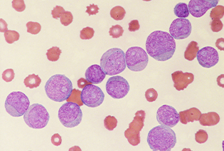 Chronic Myeloid Leukemia