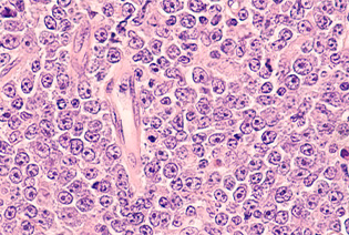 Hodgkin Lymphoma
