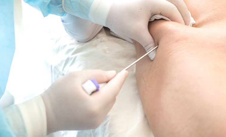 Bone Marrow Aspiration