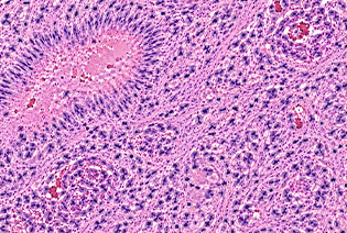 Astrocytoma