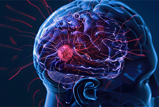 Gliomas
