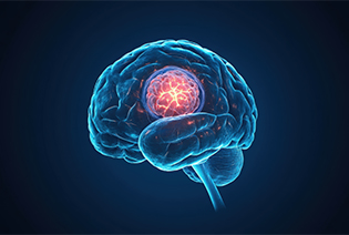 Metastatic Brain and Spinal Tumours