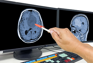 Oligodendroglioma