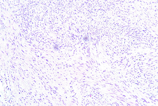 Schwannoma
