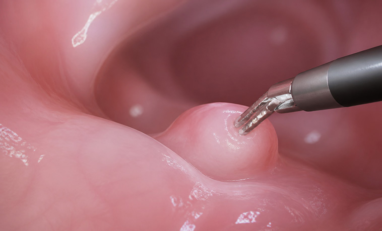 Endoscopic Biopsy