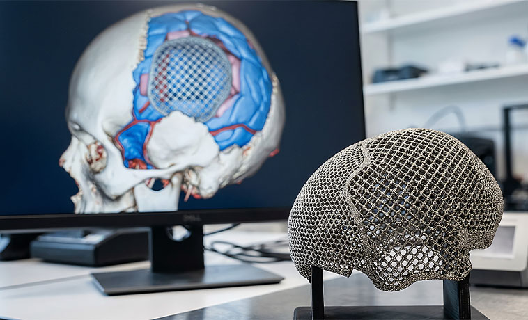 Cranioplasty