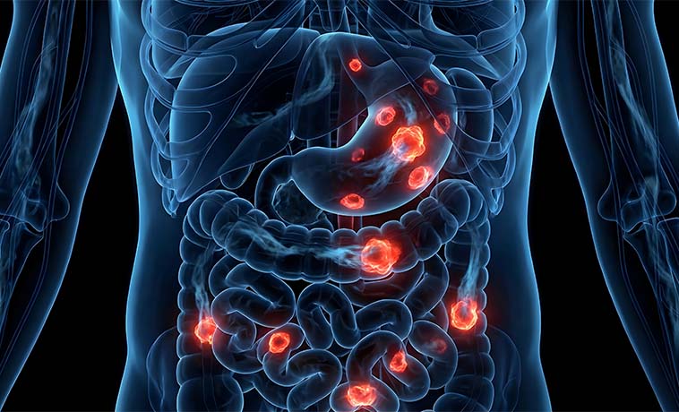 Peptide Receptor Radionuclide Therapy