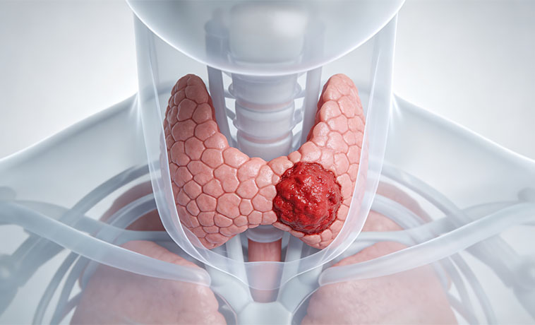 Surgery for Recurrent or Metastatic Disease