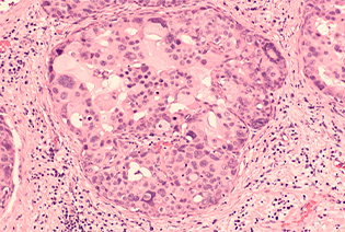 Ductal Carcinoma in Situ (DCIS)