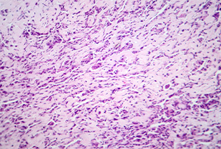 Osteosarcoma
