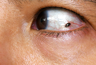 Uveal Melanoma