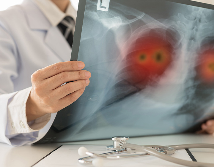 Thoracic Cancer