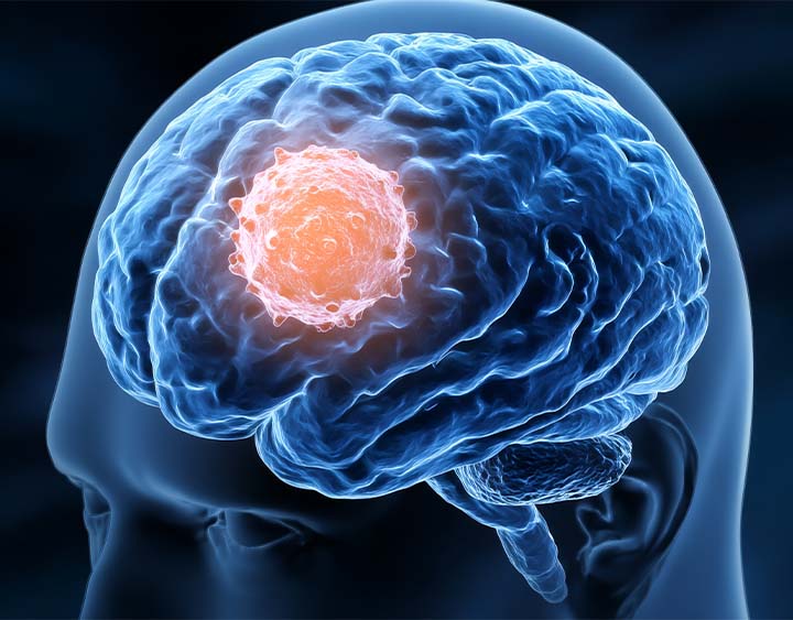 Neurological Cancer