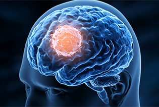 Neurological Cancer