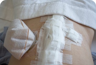 Wound and stoma care
