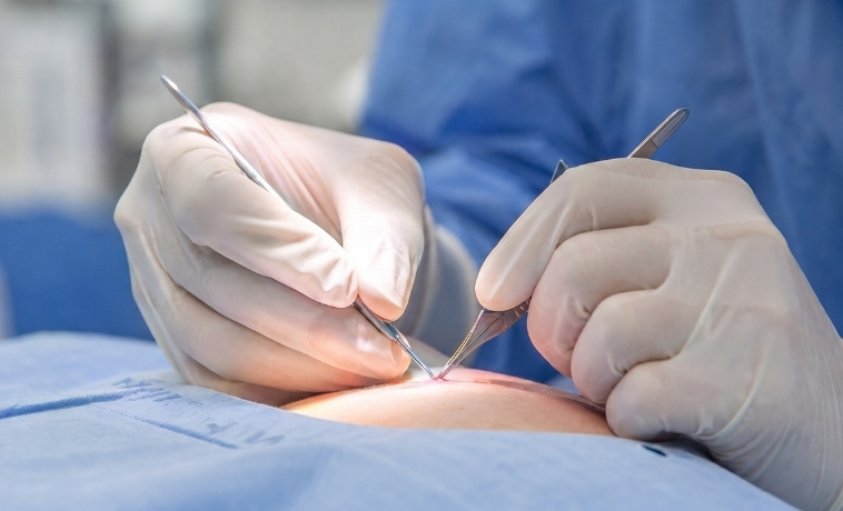 Biopsy