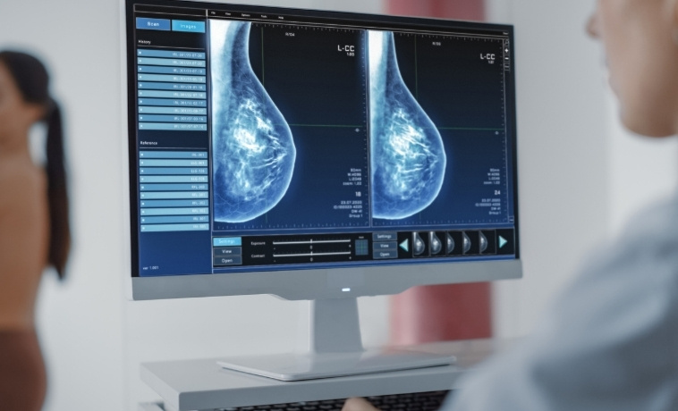 Mammography