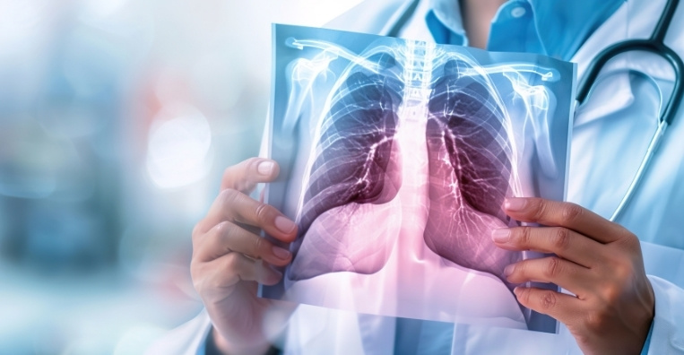 Your Screening Journey at Apollo Cancer Centres Lung Cancer