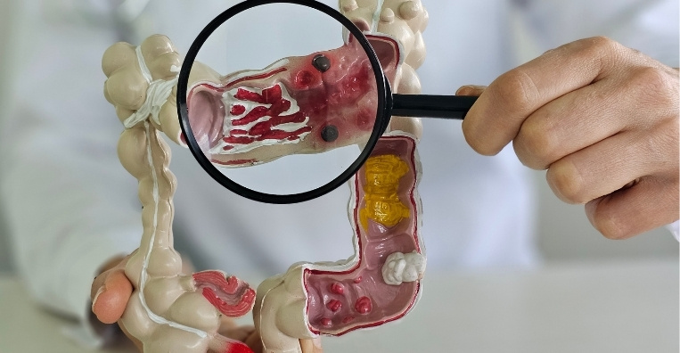 Why Screening Is Important