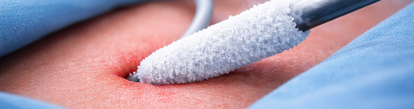 Cryoablation