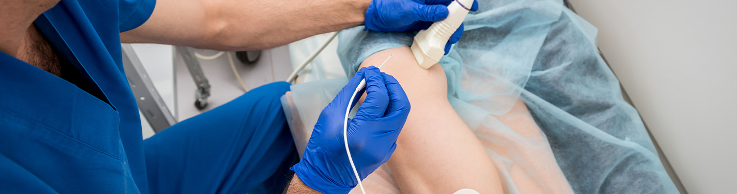 Radiofrequency Ablation (RFA)