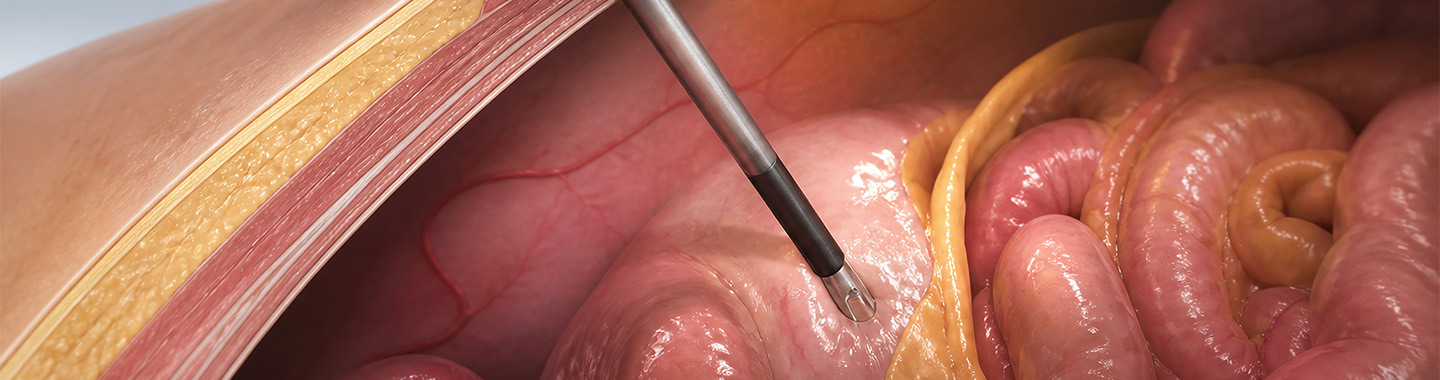 Hyperthermic Intraperitoneal Chemotherapy (HIPEC)