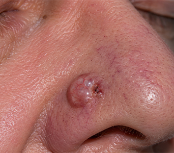 Support for Appropriate Cancer Removal