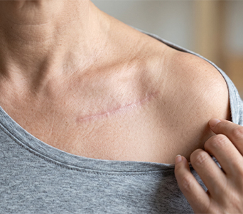 Replacement of Radiation-Damaged Tissue