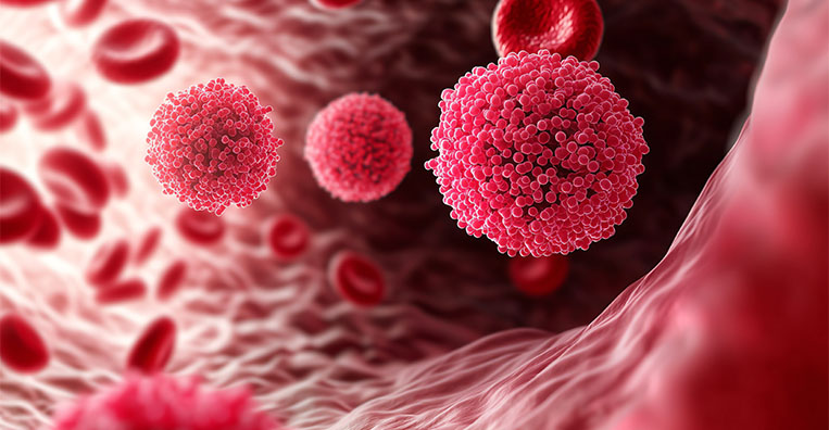 Stereotactic Body Radiation Therapy (SBRT)