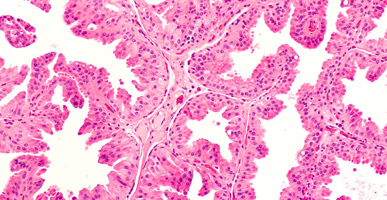 Cryoablation