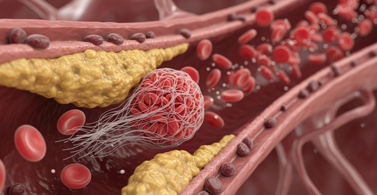 Embolisation Therapy