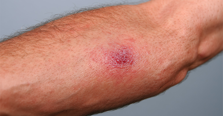 Radiofrequency Ablation (RFA)
