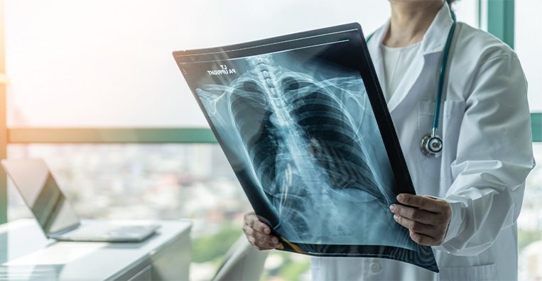 Stereotactic Body Radiation Therapy (SBRT)