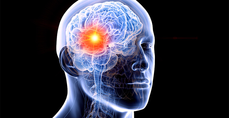 ZAP-X Radiosurgery