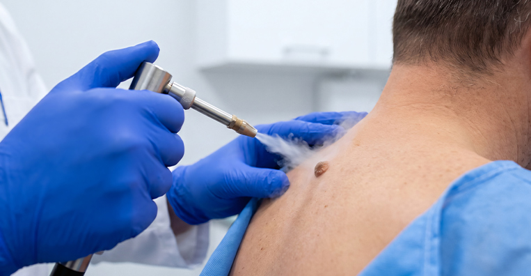 Cryoablation Treatment