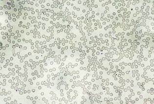 Aplastic anaemia