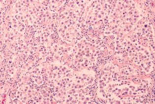 Sickle cell disease or thalassaemia