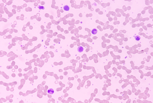 Myelodysplastic syndromes