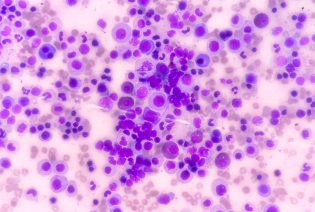 Myeloproliferative neoplasms