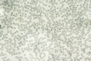 Aplastic anaemia