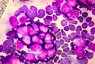 B-cell acute lymphoblastic leukemia