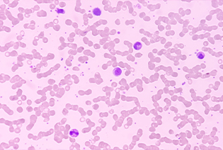 Diffuse large B-cell lymphoma